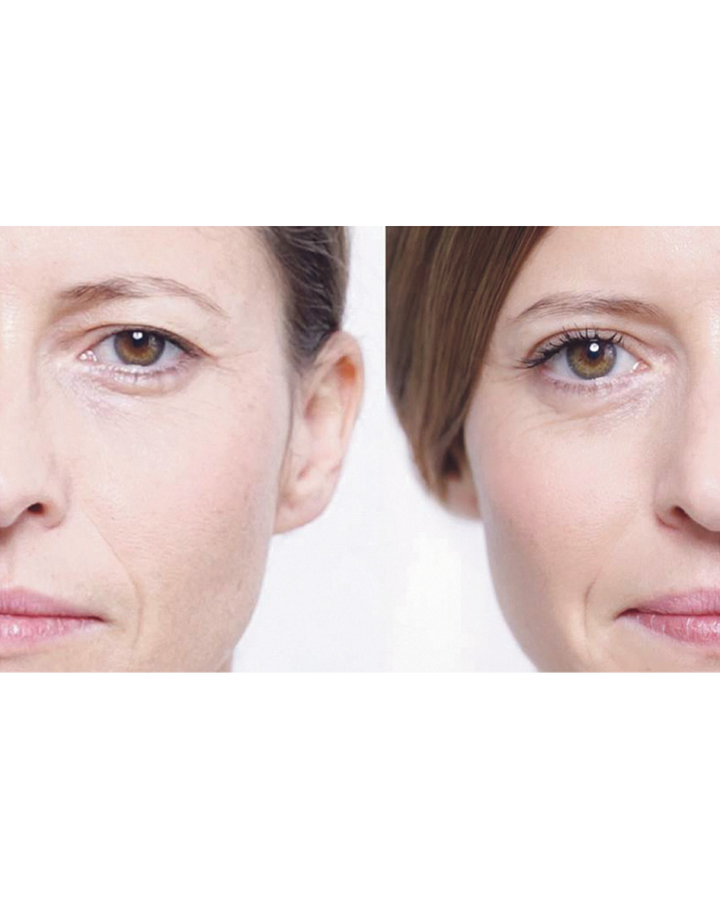 תוצאות לפני ואחרי שימוש במדבקות העיניים להרמת העפעף העליון למראה עיניים צעירות וזוהרות